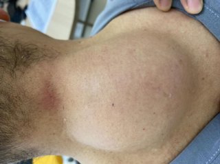 把“脂肪瘤”当“富贵包” 老汉后颈疼痛难忍