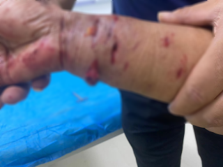 遭遇狗咬怎么办 国际医学整外医生来支招