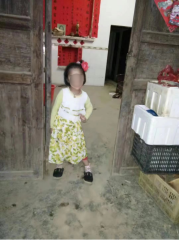 国际医学爱心赓续 助11岁“小耳”女童种耳成功